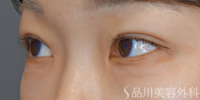 症例NO.71685のAFTER写真