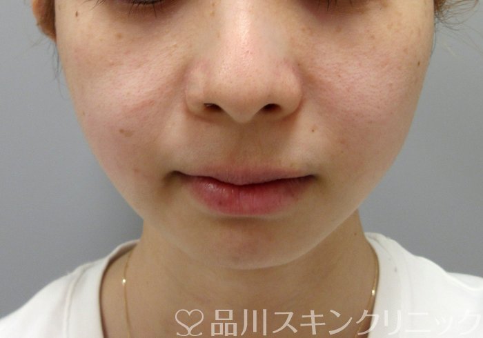 症例NO.73545のBEFORE写真