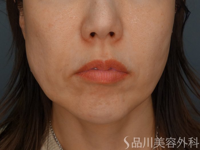 症例NO.69967のBEFORE写真