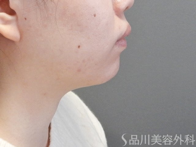 症例NO.67998のBEFORE写真