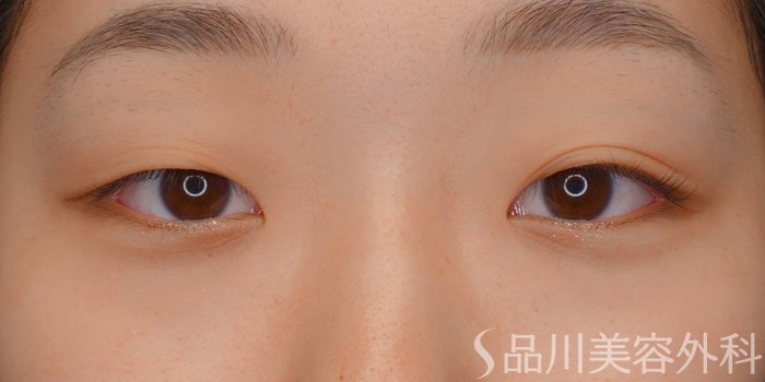 症例NO.74315のBEFORE写真