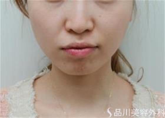 症例NO.47381のBEFORE写真