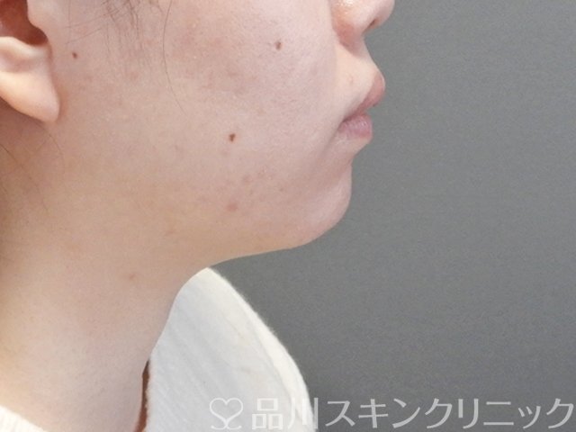 症例NO.67998のBEFORE写真