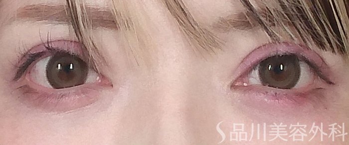 症例NO.64987のAFTER写真
