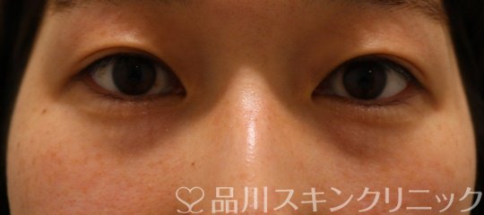 症例NO.62581のBEFORE写真