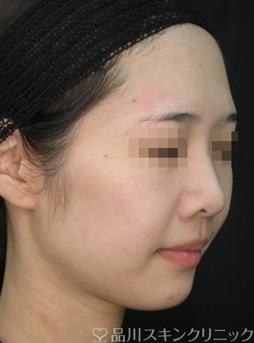 症例NO.72243のBEFORE写真