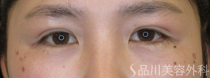 症例NO.71690のAFTER写真