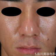 症例NO.72946のBEFORE写真