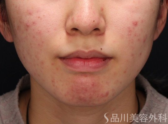 症例NO.67704のBEFORE写真