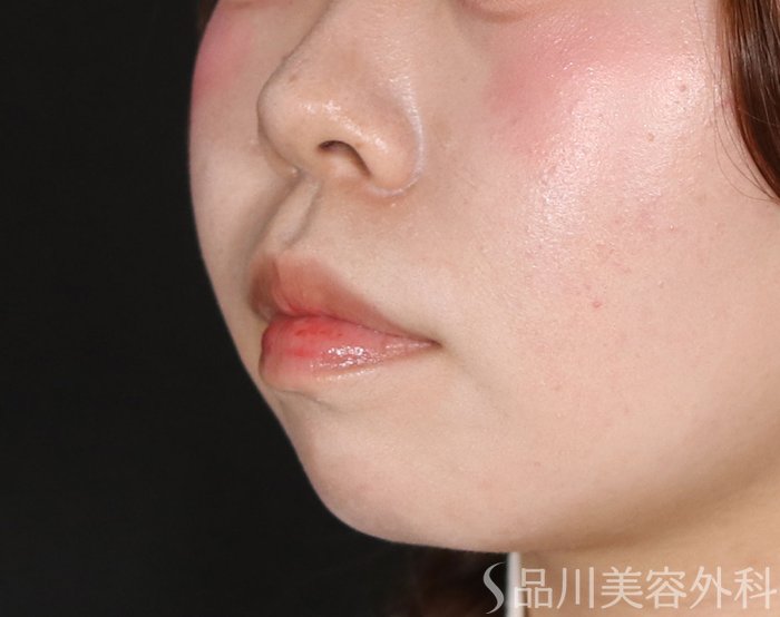 症例NO.72783のBEFORE写真