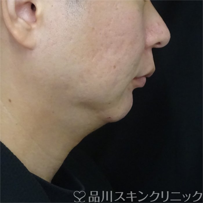 症例NO.72629のBEFORE写真