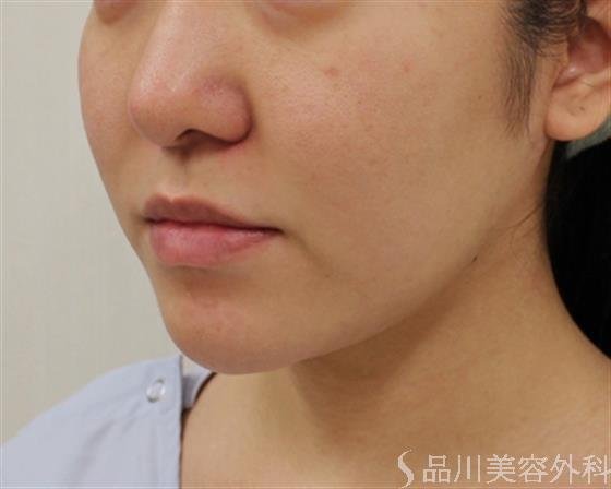 症例NO.29259のBEFORE写真