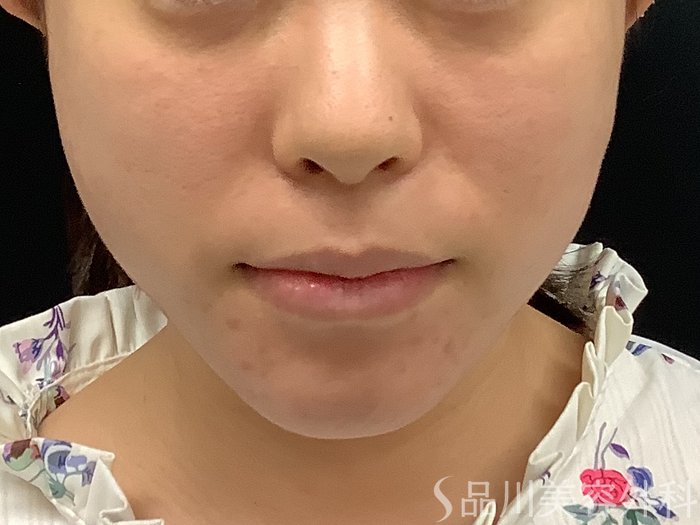 症例NO.71000のAFTER写真
