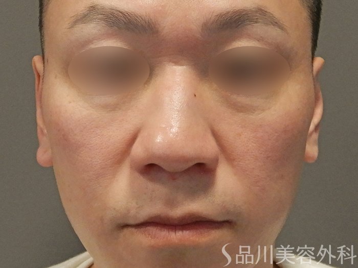 症例NO.70476のBEFORE写真