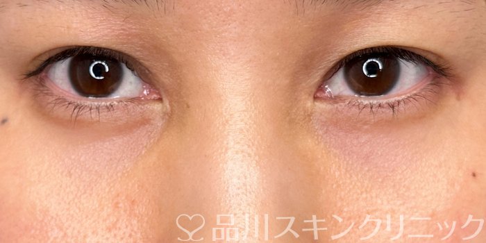 症例NO.70294のAFTER写真