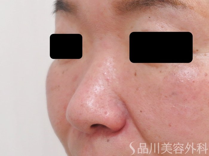 症例NO.69541のBEFORE写真