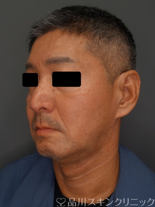 症例NO.74205のBEFORE写真