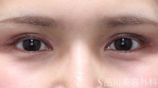 症例NO.75188のAFTER写真