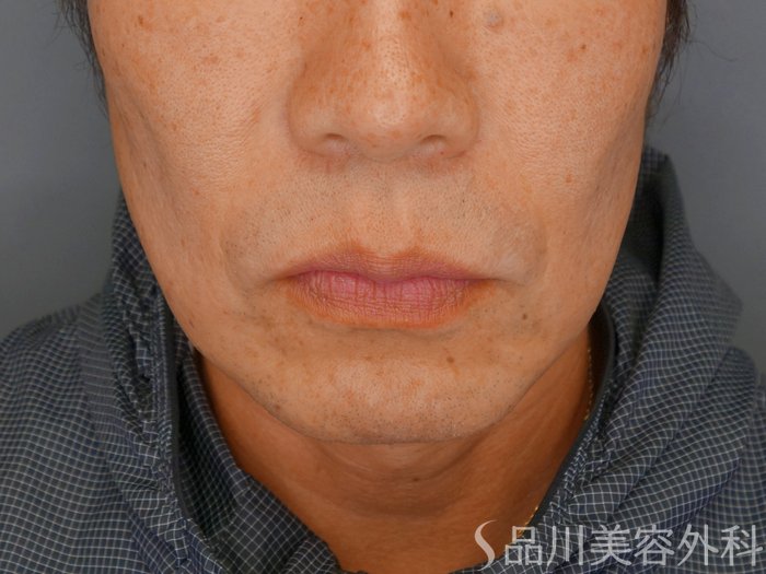 症例NO.70039のBEFORE写真