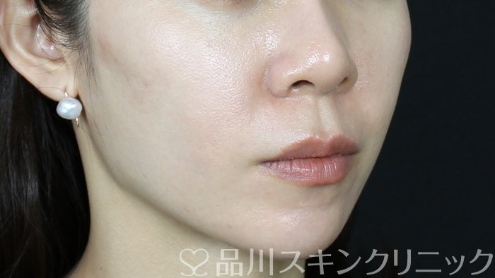 症例NO.71676のAFTER写真