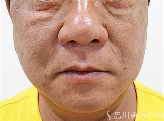 症例NO.55577のAFTER写真