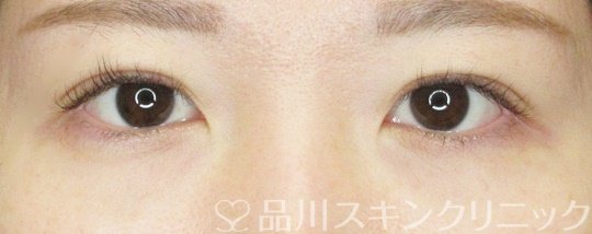 症例NO.69429のAFTER写真