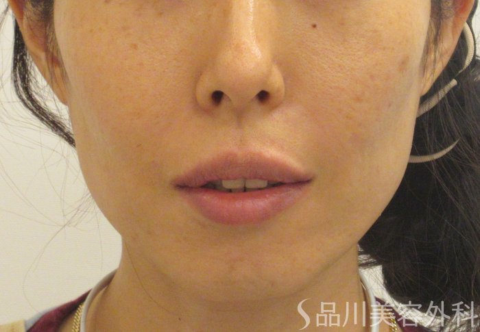 症例NO.71371のAFTER写真