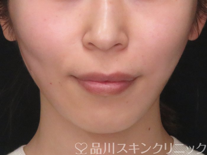 症例NO.69296のAFTER写真