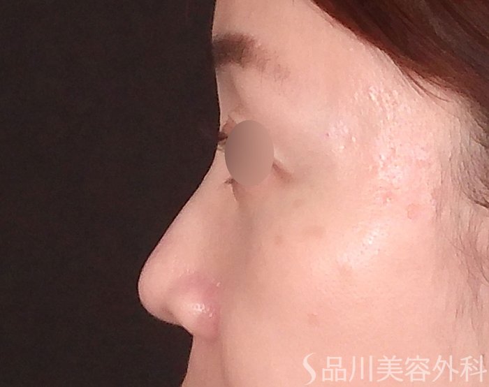 症例NO.70440のBEFORE写真