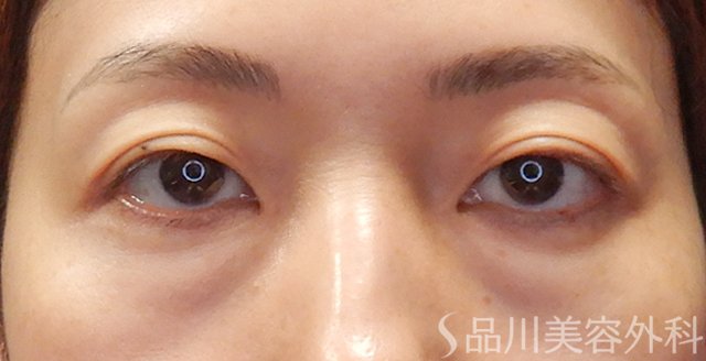 症例NO.73999のBEFORE写真