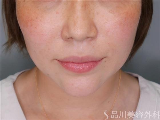 症例NO.51241のBEFORE写真