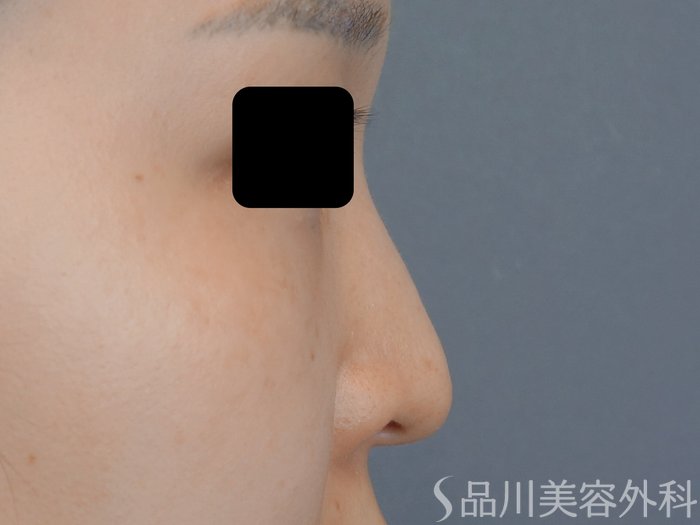 症例NO.70532のBEFORE写真