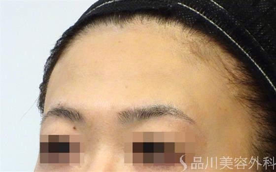 症例NO.33023のBEFORE写真