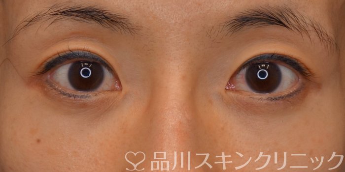 症例NO.74054のBEFORE写真