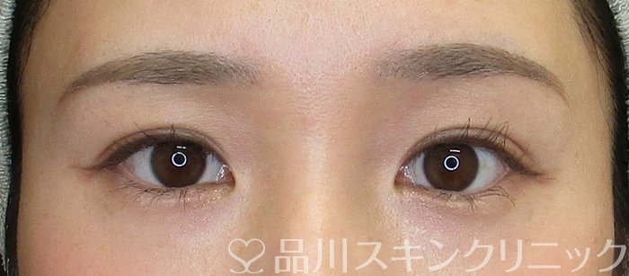 症例NO.72752のAFTER写真