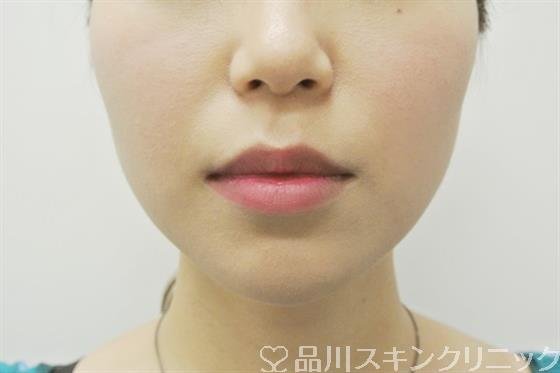 症例NO.35445のAFTER写真