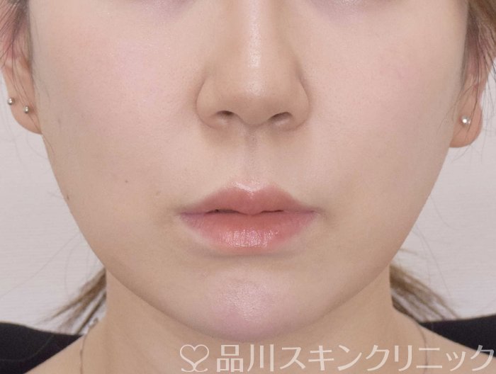 症例NO.69738のAFTER写真