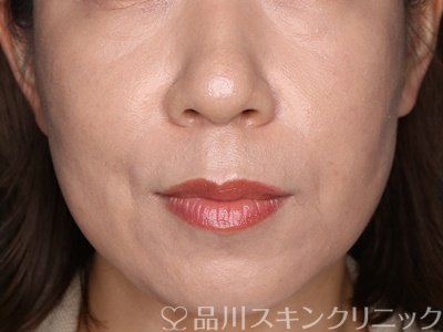 症例NO.71753のAFTER写真