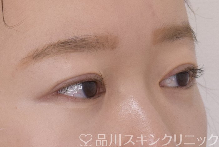 症例NO.69571のAFTER写真