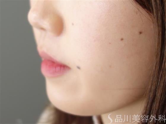 症例NO.49712のBEFORE写真