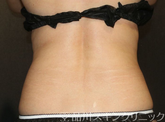 症例NO.72899のAFTER写真