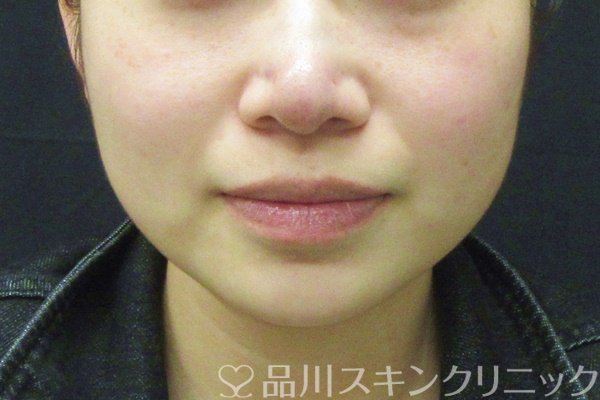症例NO.65041のAFTER写真