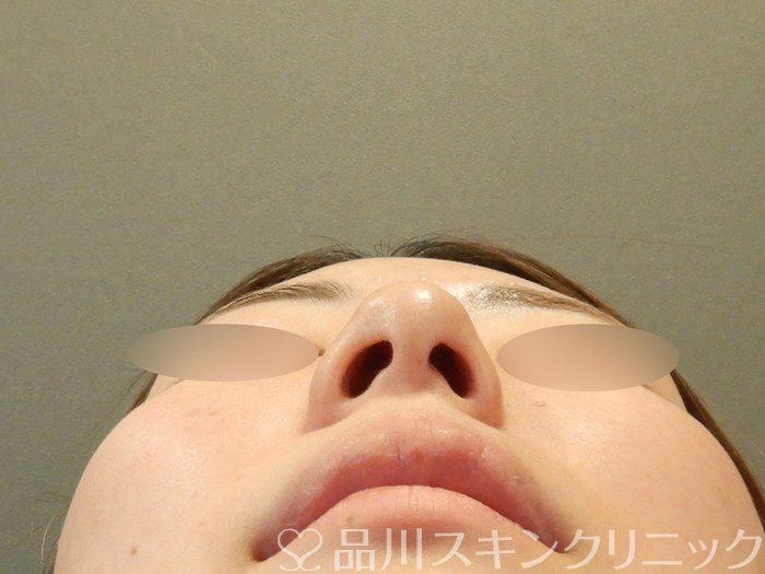 症例NO.63493のBEFORE写真