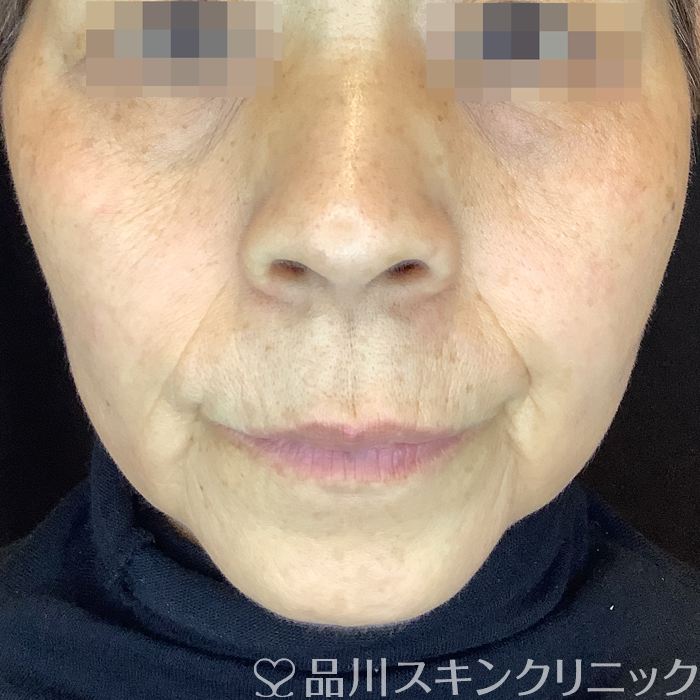 症例NO.62046のBEFORE写真