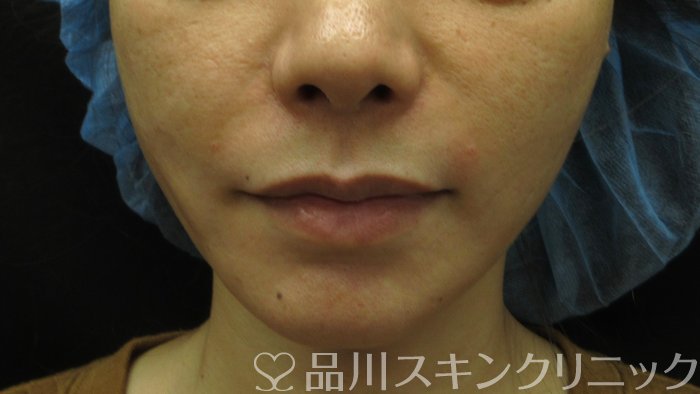 症例NO.70504のAFTER写真