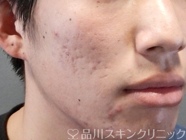 症例NO.68896のBEFORE写真