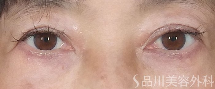 症例NO.70092のBEFORE写真
