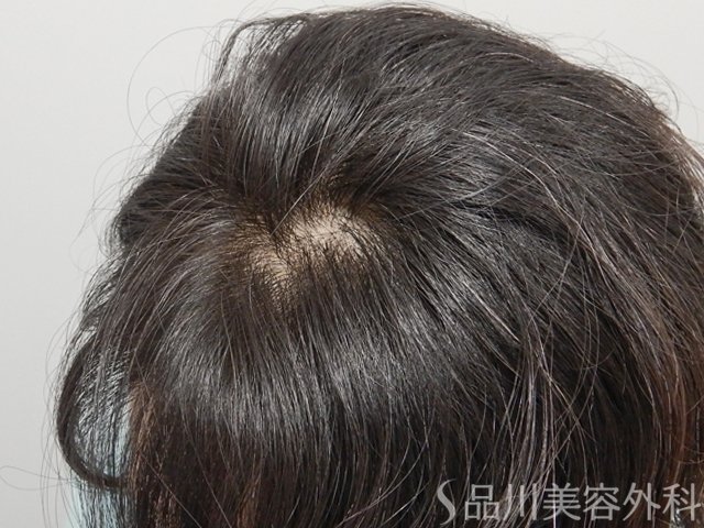 症例NO.72889のAFTER写真