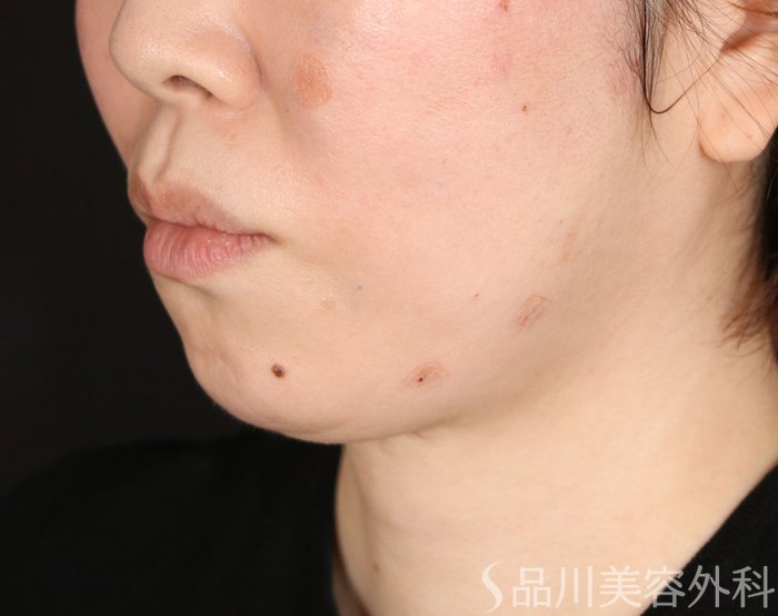 症例NO.74139のAFTER写真