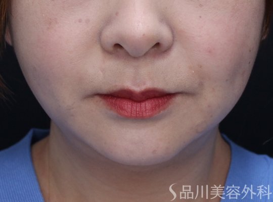 症例NO.74350のAFTER写真
